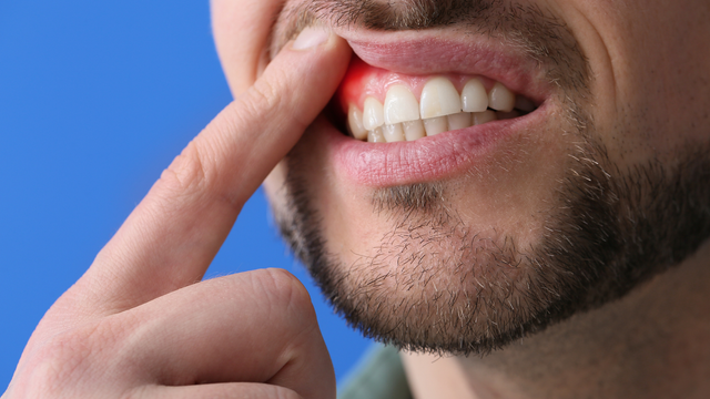 Image of a dental x-ray scan of a patient's tooth in Tustin, CA