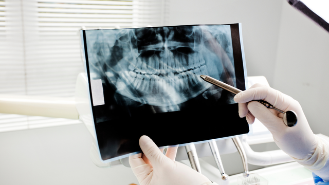 Image of a dental x-ray scan of a patient's tooth in Tustin, CA