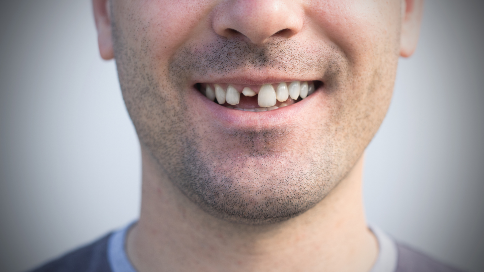 picture of Knocked-Out Teeth