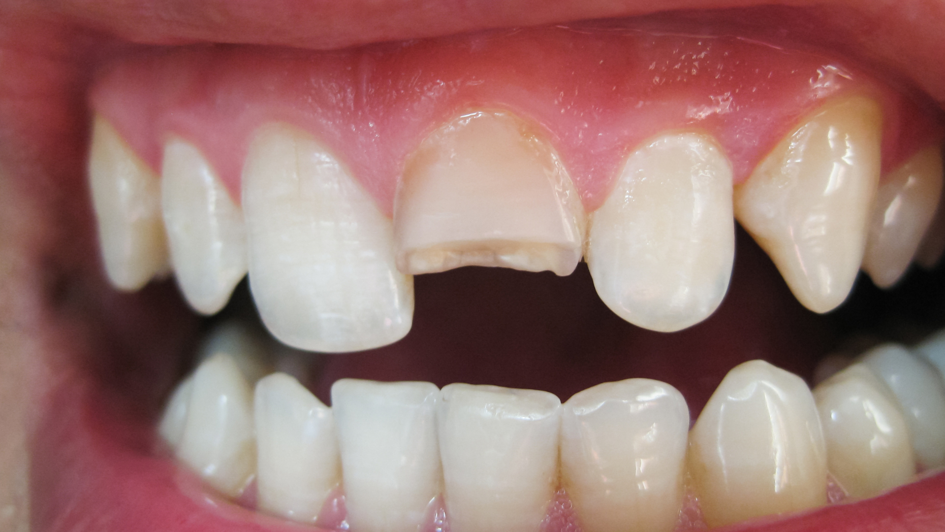 Picture of a Chipped or Broken Teeth