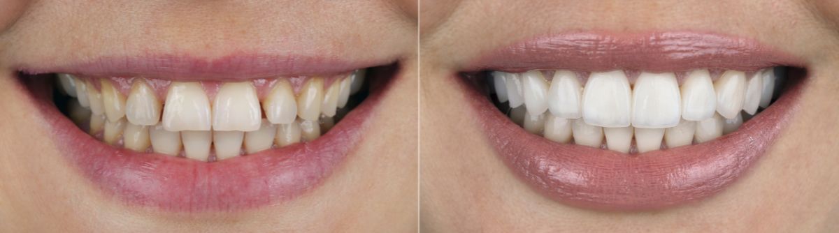 A before and after picture of a woman 's teeth.