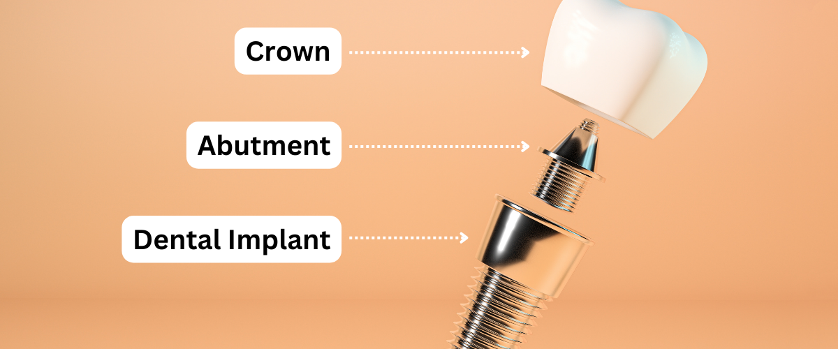 Dental Implant Breakdown: Three Key Parts | Dental Implants in Tustin, CA